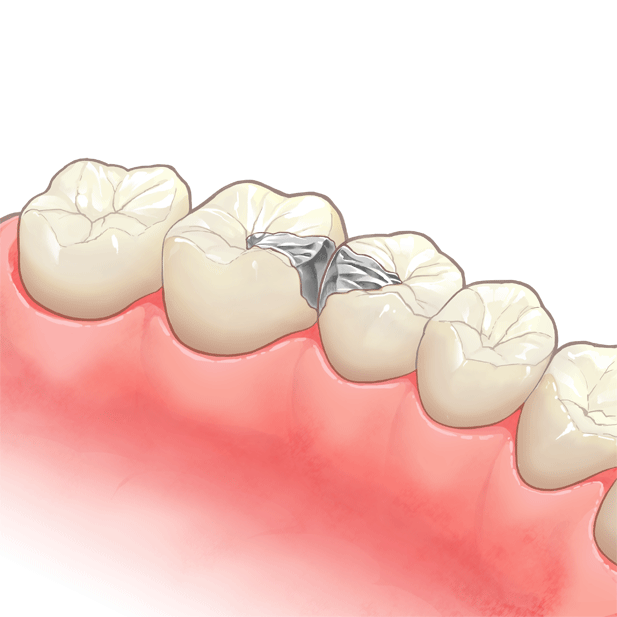 むし歯の除去