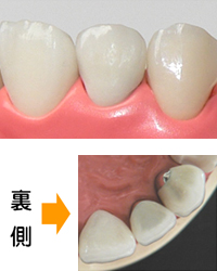 かぶせ物（クラウン）